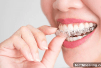 The Invisible Advantage of Invisalign