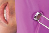 Amalgam Removal: A Step-by-Step Guide