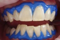 Kenmore Dentist Warns About Teeth Whitening Risks