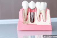 What You Need to Know Before Getting Dental Implants