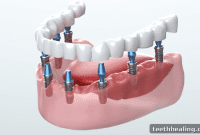 Reclaim Your Smile: Dental Implants The Superior Solution for Missing Teeth