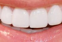 The Right Smile Makeover For You: A Personal Guide