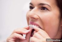 Invisalign’s Secret Blueprint: Mastering Invisible Smile Transformations