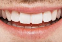 Reveal a Brighter Smile: Replacing Metal Fillings