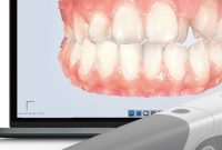 3D Teeth Scans Replace Traditional Dental Impressions
