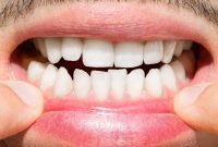 Your Clear Aligner Timeline to a Perfect Smile