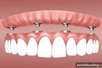 Teeth In An Hour Instant Dental Implant Solutions
