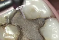 Beyond Amalgam: A Wholistic Path to Dental Health