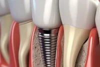 Beyond The Hype 10 Reasons Implants Arent For Everyone