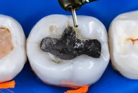 Mercury-Safe Amalgam Removal Evolve Dental Brisbane