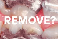 Unpacking the Motives for Amalgam Filling Removal