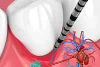 Gum Disease: A Gateway to Systemic Infection