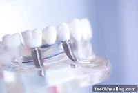 Elevate Your Smile with Porcelain Veneers