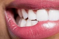 Amalgam Filling Replacement Options
