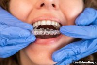 Palm Desert’s Invisalign Solution for a Brilliant Smile