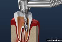 Palm Desert Root Canals: Preserving Your Natural Smile