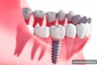Restored Smiles, Renewed Lives: Dental Implant Success Stories from Palm Desert