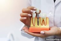 Dental Implants: Your Journey Through Treatment