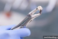 The Maximum Number of Teeth Extracted Per Visit