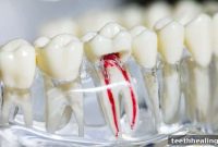 The Lifespan of a Root-Canaled Tooth