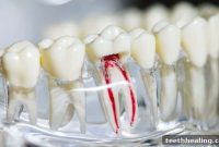 Root Canal Pain What to Expect