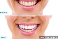 Long-Lasting Brilliance: Secrets to Maintaining White Teeth