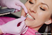 Erase Stains and Repair Chips The Power of Porcelain Veneers
