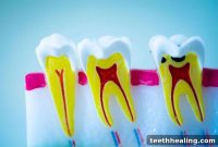 Save Your Cracked Tooth: How a Root Canal Can Help