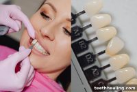 Porcelain Veneers for Tooth Gaps: Everything You Need to Know
