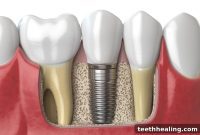 Preserving Your Jawbone: The Role of Dental Implants
