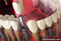 7 Dental Implant Myths Busted by Your Dentist