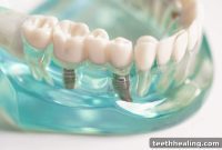Safeguard Your Smile: 7 Foods to Avoid After Dental Implant Surgery