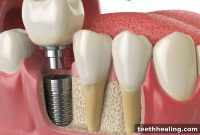 Is a Crown Enough? 5 Reasons You Might Actually Need an Implant