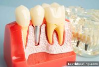 Unlock Implant Success The Power of Bone Grafting