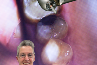 Safe Amalgam Removal Process Explained