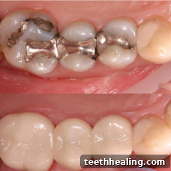 Reveal a Brighter Smile: Replacing Metal Fillings 2 before and after amalgam removal