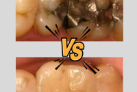 The Dental Filling Decision Composite Versus Amalgam