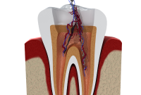 Silent Tooth Infection That May Be Impacting Your Whole Body