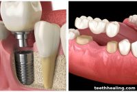 Dental Implant vs Dental Bridge: Choosing the Right Solution for Missing Teeth